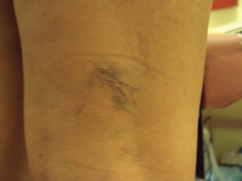Sclerotherapy before 1046955