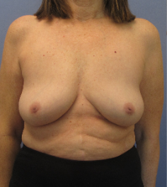 Breast Implant Removal after 3611188