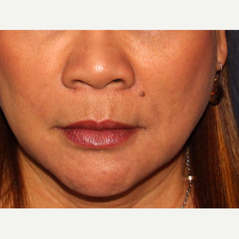18-24 year old woman treated with Radiesse after 3110441