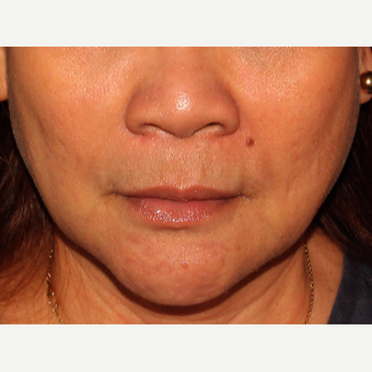 18-24 year old woman treated with Radiesse before 3110441