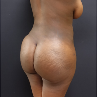 25-34 year old woman treated with SAFELipo after 3363787