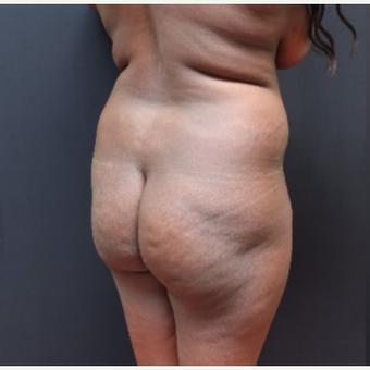 25-34 year old woman treated with SAFELipo before 3363787