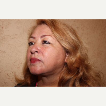 Facelift after 3454772