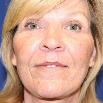 65-74 year old woman treated with Lip Lift after 1863367