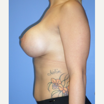 25-34 year old woman treated with Breast Implant Revision after 3370301