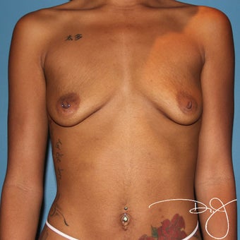 18-24 year old woman treated with Breast Augmentation before 1560049