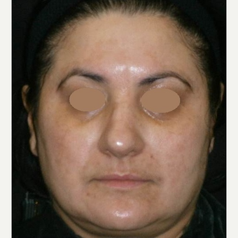 45-54 year old woman treated with Chemical Peel after 3153435