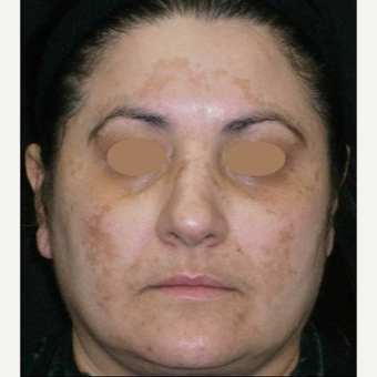 45-54 year old woman treated with Chemical Peel before 3153435
