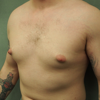 18-24 year old Male treated with Male Breast Reduction before 3089156