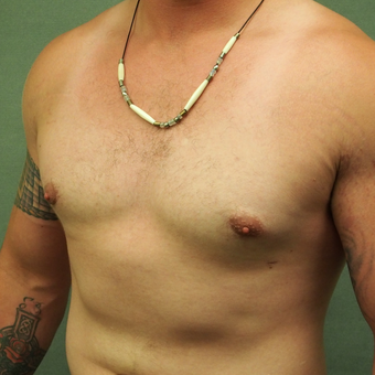18-24 year old Male treated with Male Breast Reduction after 3089156