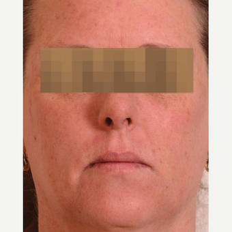 Halo Laser after 1833347