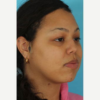 25-34 year old woman treated with Rhinoplasty before 3628886
