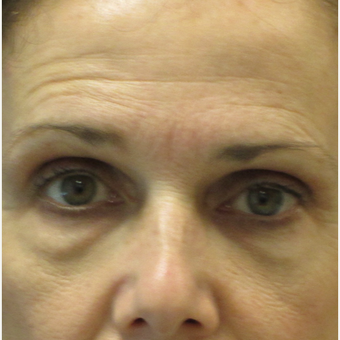 45-54 year old woman treated with Eyelid Surgery before 3802446