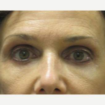 45-54 year old woman treated with Eyelid Surgery after 3802446
