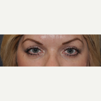 45-54 year old woman treated with Eyelid Surgery after 3508737