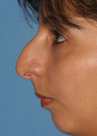 25-34 year old woman treated with Rhinoplasty before 2106936