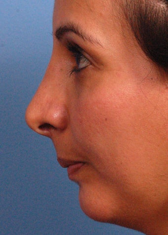 25-34 year old woman treated with Rhinoplasty after 2106936
