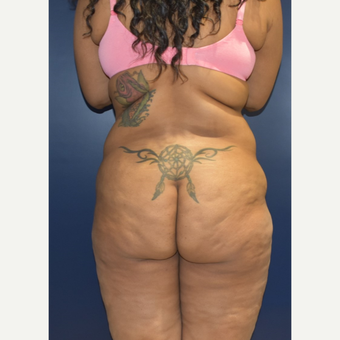 25-34 year old woman treated with Brazilian Butt Lift before 3734059
