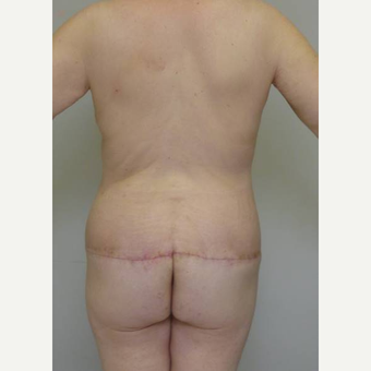 35-44 year old woman treated with Body Lift after 3402364