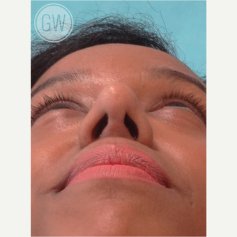 25-34 year old woman treated with Rhinoplasty and alar base reduction after 3472399