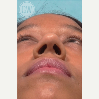 25-34 year old woman treated with Rhinoplasty and alar base reduction before 3472399