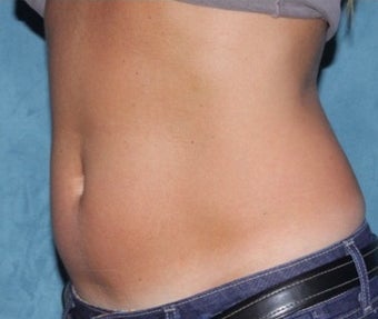 Coolsculpting after 374864