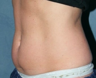 Coolsculpting before 374864