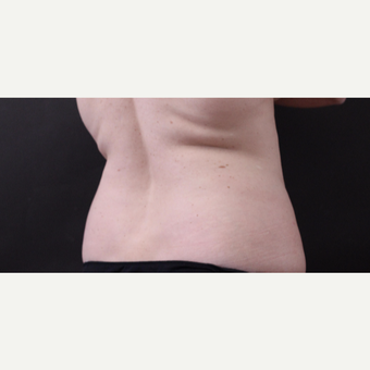 46 year old woman treated with CoolSculpting after 3168903