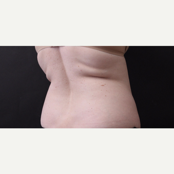 46 year old woman treated with CoolSculpting before 3168903