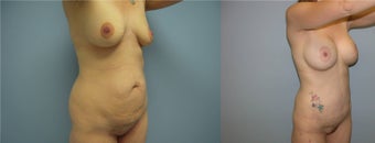 liposuction, breast augmentation, mommy makeover, tummy tuck after 521132