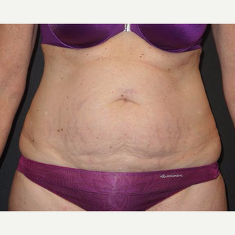 45-54 year old woman treated with Tummy Tuck before 3458172