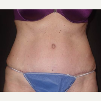 45-54 year old woman treated with Tummy Tuck after 3458172