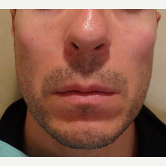 35-44 year old man treated with Radiesse after 3744617