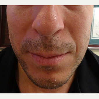 35-44 year old man treated with Radiesse before 3744617
