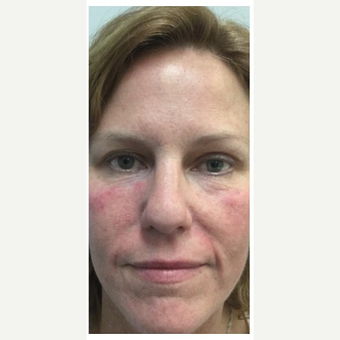35-44 year old woman treated with Wrinkle Treatment after 2894157