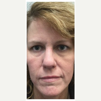 35-44 year old woman treated with Wrinkle Treatment before 2894157