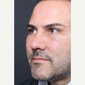 35-44 year old man treated with Rhinoplasty before 3065355