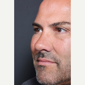 35-44 year old man treated with Rhinoplasty after 3065355