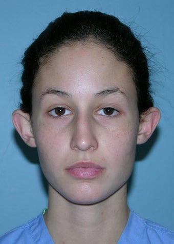 Otoplasty before 1320756