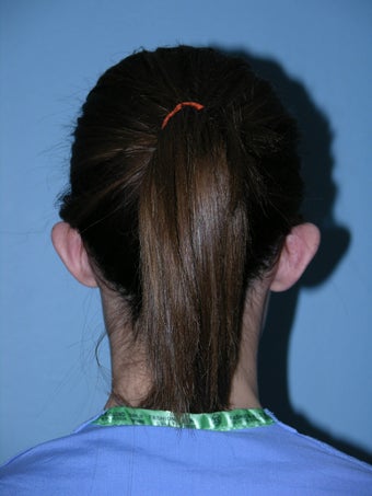Otoplasty 1320756