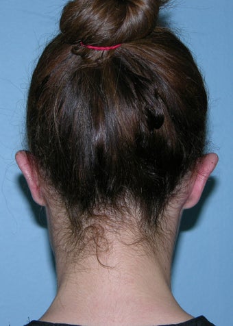 Otoplasty 1320756