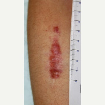 25-34 year old man treated with Scar Removal before 2551315