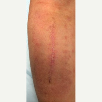 25-34 year old man treated with Scar Removal after 2551315