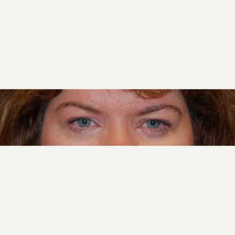 45-54 year old woman treated with Eyelid Surgery before 3042901