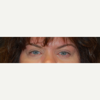 45-54 year old woman treated with Eyelid Surgery after 3042901