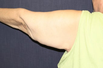 Arm Lift (Brachioplasty) after 508323