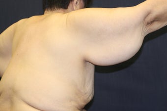 Arm Lift (Brachioplasty) 508323
