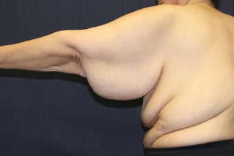 Arm Lift (Brachioplasty) before 508323