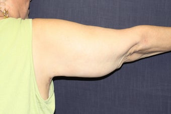 Arm Lift (Brachioplasty) 508323
