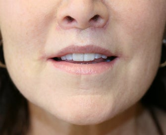 Lip Lift and Corner of Lip Lift after 917034